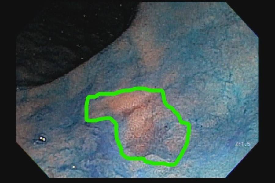 Metaplasia Intestinal no Estômago e a Cromoscopia: no que consistem?